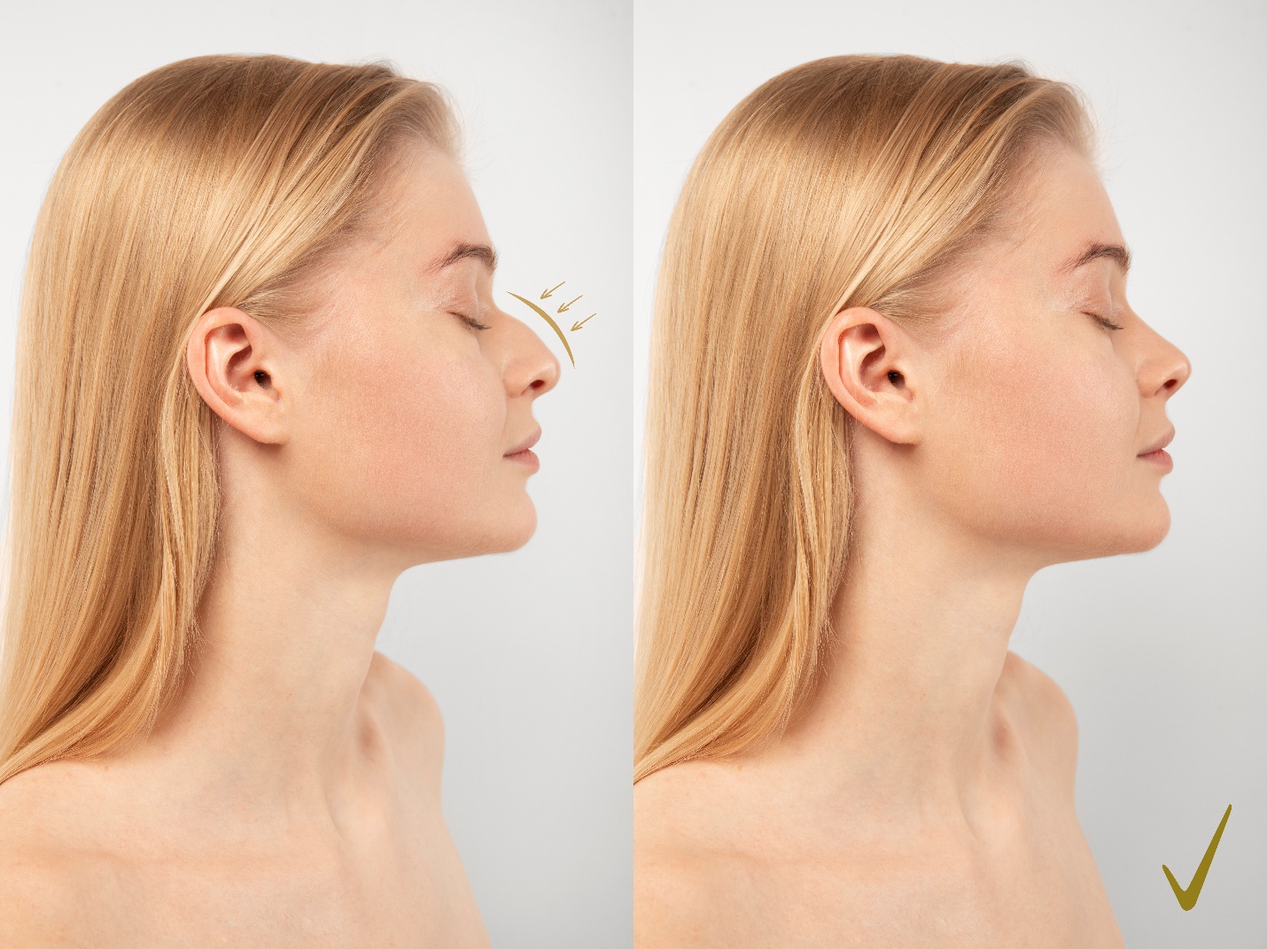 Tout savoir sur la rhinoplastie